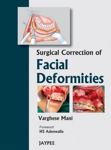 Surgical Correction of Facial Deformities