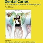 Dental Caries : The Disease and its Clinical Management 3rd Edition