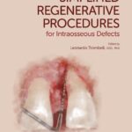 Simplified Regenerative Procedures for Intraosseous Defects