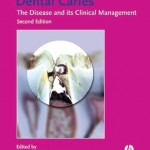 Dental Caries: The Disease and Its Clinical Management