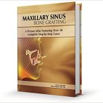 Maxillary Sinus Bone Grafting: A Picture Atlas Featuring over 50 Complete Step-By-Step Cases