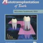 Autotransplantation of Teeth