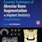 Essential Techniques of Alveolar Bone Augmentation in Implant Dentistry : A Surgical Manual